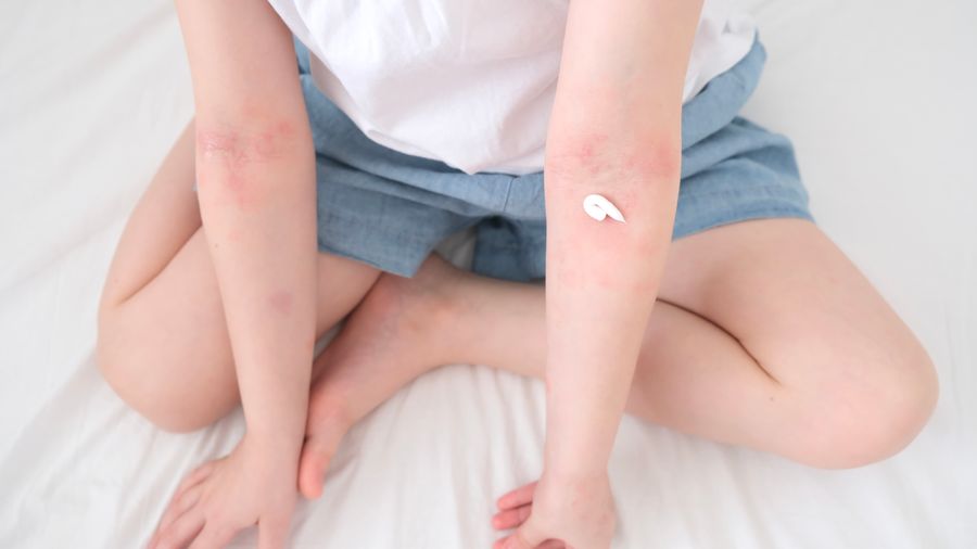 Ist Neurodermitis ansteckend?