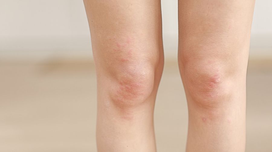 Neurodermitis und Schuppenflechte